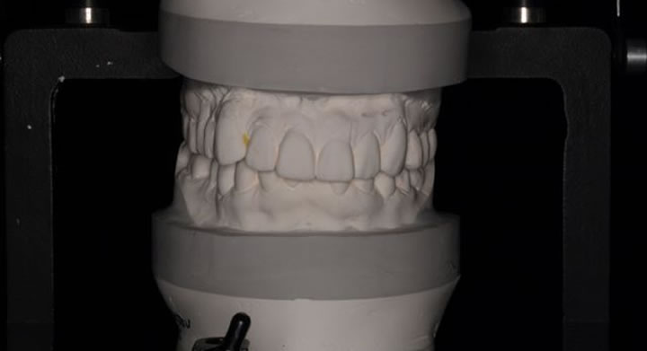 咬合器（患者様の歯並び、歯の大きさ、咬み合わせ、顎関節の位置を診査するための器機です）